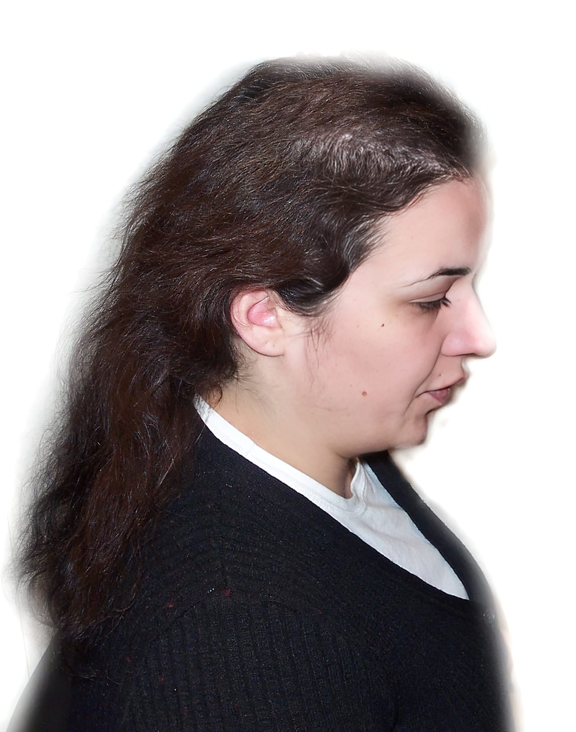 Before Picture - Trichotillomania Success - Now Pull-Free